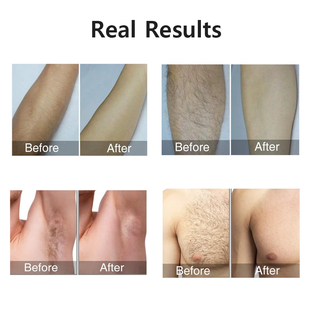 Laser Epilator Laser Permanent Depilator