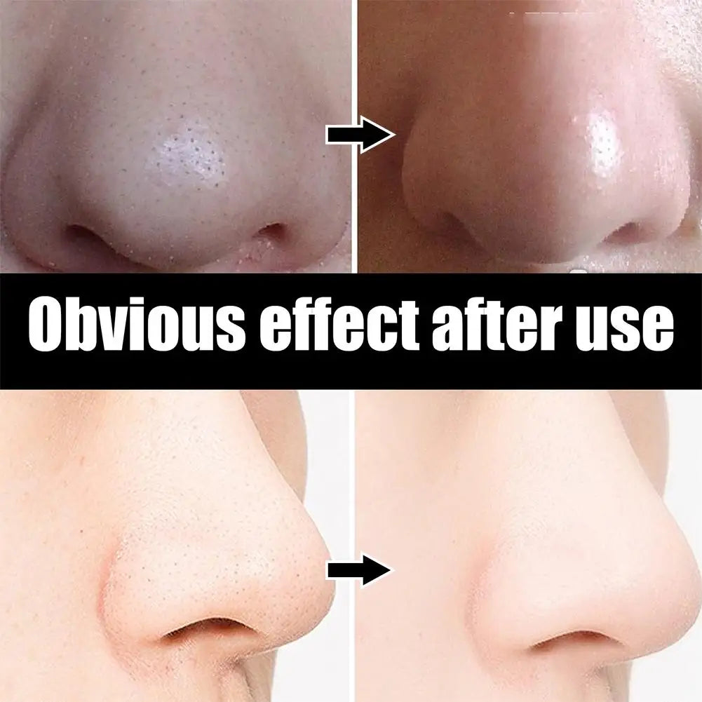 10pcs Box Blackhead Remover Nose Strips