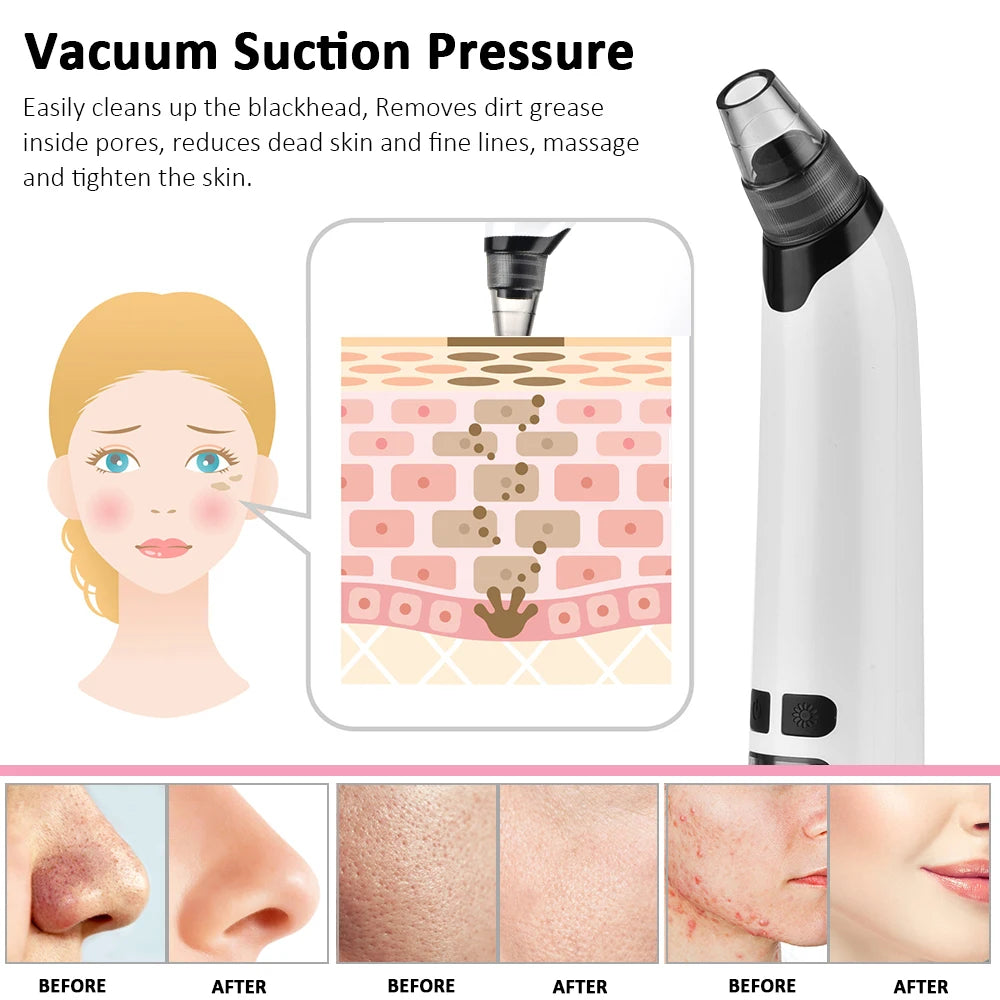 Facial Blackhead Remover Pore Cleaner Heat Function