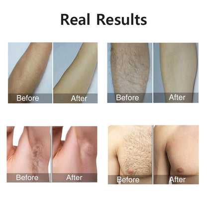 Laser Epilator Laser Permanent Depilator